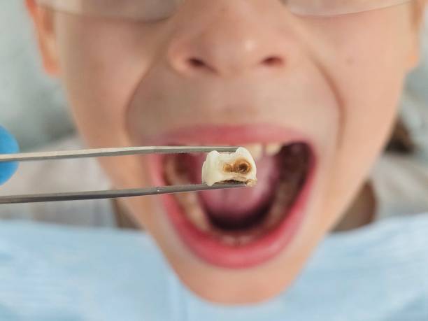 Best Emergency Wisdom Tooth Extraction in White City, OR